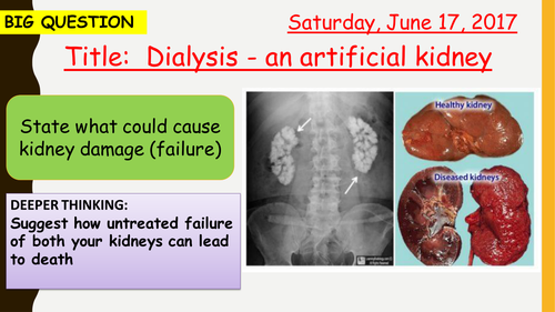 AQA new specification-Dialysis-Artificial Kidney-B12.4