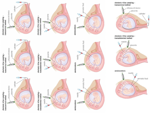 AQA GCSE Biology (9-1) B13.10 - Screening for genetic disorders FULL LESSON