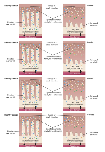 LO4 Know how food can cause ill health (WJEC) | Teaching Resources